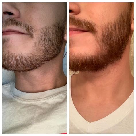 Patchy Beard Growth Before And After