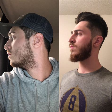 Patchy Beard Growth Progress