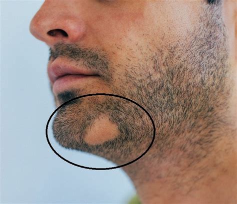 Patchy Beard Under Chin