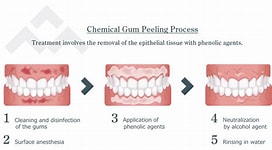 Peeling Gums Professional Treatments