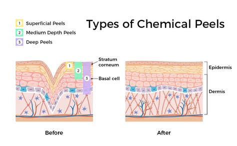 Peels and Exfoliants