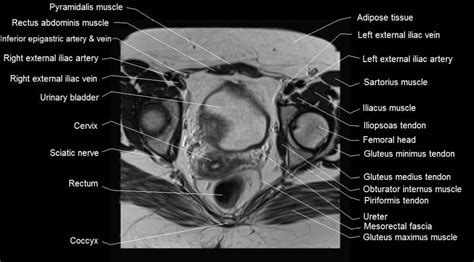 MRI pelvis anatomy free male pelvis axial anatomy