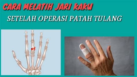 Pemulihan otot jari tangan pascapatah tulang di Indonesia