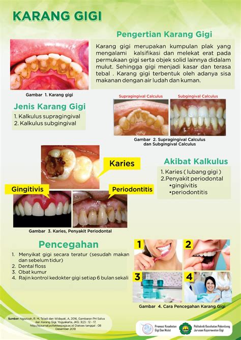Pencegahan Karang Gigi