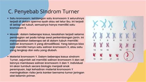 Penderita Sindrom Turner Memiliki Formulasi Kromosom