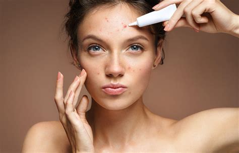 Female Adult Acne Treatment