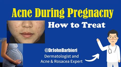 Pregnant woman with acne