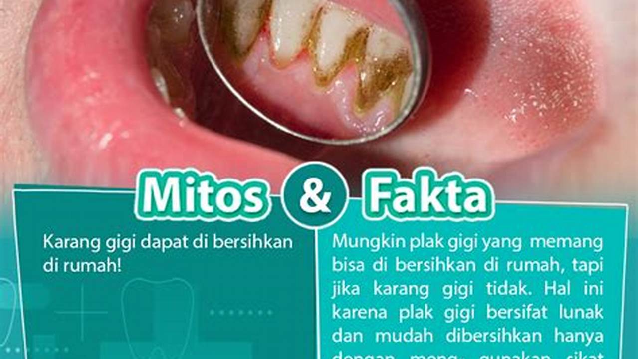 Pengurangan Karang Gigi, Resep7-10k