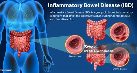 Penyakit Radang Usus