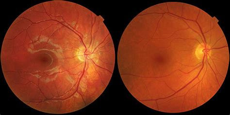 Penyakit Ablasi Retina (Retina Ablation)