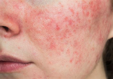 Acne Medication Side Effects