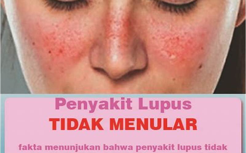 Penyebab Lupus