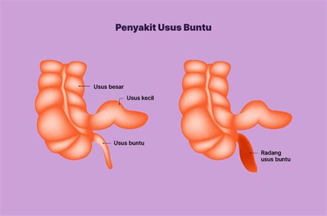 Penyebab Usus Buntu