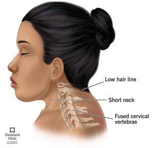 Overcoming Social Stigma: The Untold Struggles and Triumphs of People with Short Necks