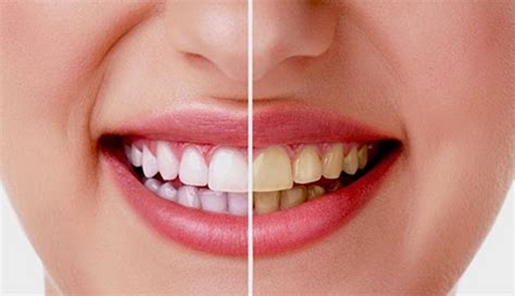 Perawatan Gigi yang Tepat untuk Memutihkan Gigi