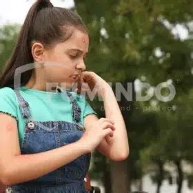 Perawatan Setelah Digigit Nyamuk