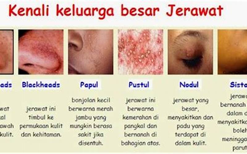 Perbedaan Jerawat Dan Alergi