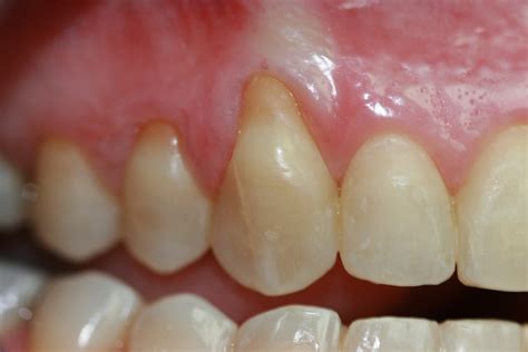 Pérdida de encía: Causas y Tratamiento - Clínica Larrañaga