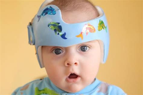Perhatian khusus saat mengatasi kepala peyang pada bayi