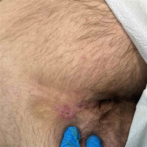 Say Goodbye to Embarrassment: The Ultimate Guide to Perianal Skin Tag Removal