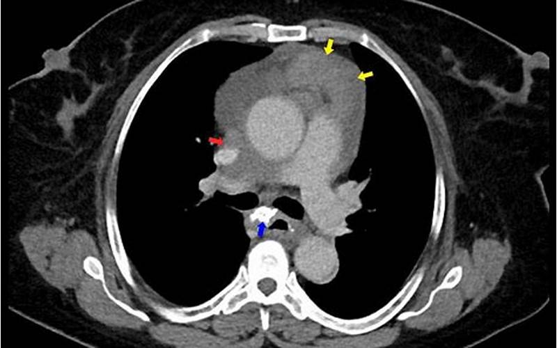 Pericardial Mesothelioma Ct Scan