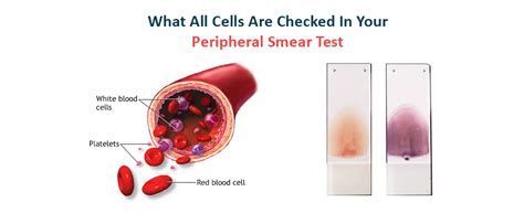 Peripheral Blood Smear Test and interpretation