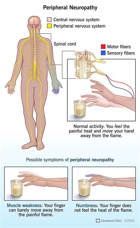 Peripheral Neuropathy: The Hidden Culprit