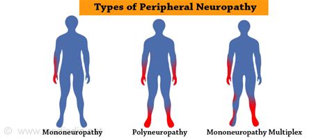 Peripheral Neuropathy The Most Common Form