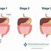 Peritoneal Mesothelioma Stage 4