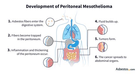 Peritoneal Mesothelioma Survival Rate