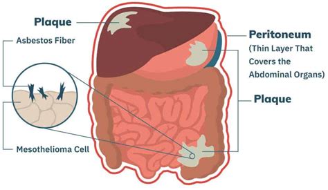 Peritoneal mesothelioma Mesothelioma