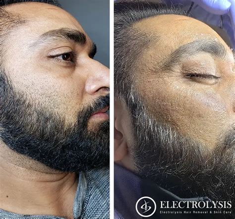 Permanent Beard Removal