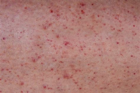 Petechien Bilder