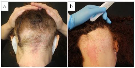Hair loss in women following COVID19 infection Glamorous Butterfly