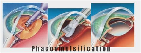Phacoemulsification (Phaco)