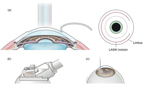 Phase 2: Creating the Corneal Flap