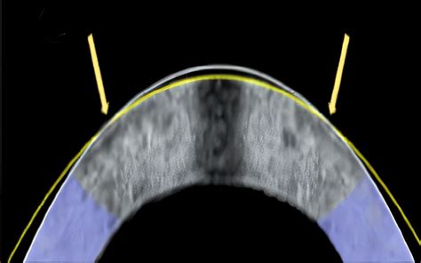 Phase 3: Reshaping the Cornea