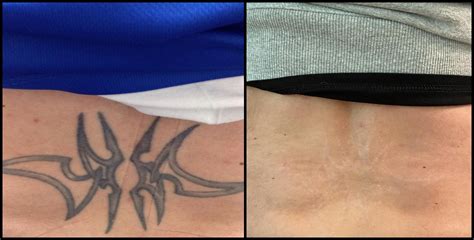 Tattoo Removal Philadelphia Neck beforeafter March