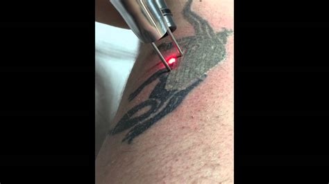 Phoenix Tattoo Removal Procedure Demo Using Zimmer Cryo