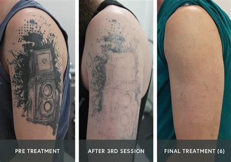 PicoSure Laser Tattoo Removal Before & After Pic