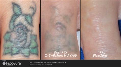 Picosure Tattoo Removal Before And After