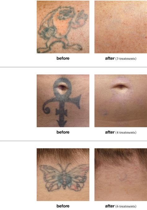 Professional Multicolored Tattoo Removal With PicoSure