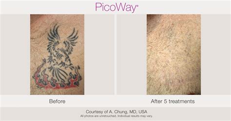 Picoway Tattoo Removal
