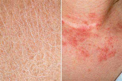 Top 10 Pictures of Excessively Dry Skin that Will Leave You Feeling Moisturized