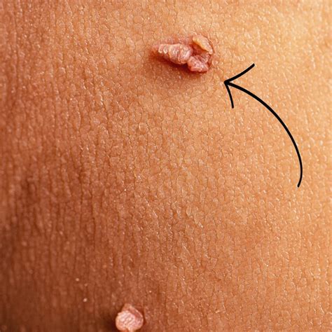 Captivating Snapshots of Oversized Skin Tags: Get a Glimpse of the Lumpy Reality!