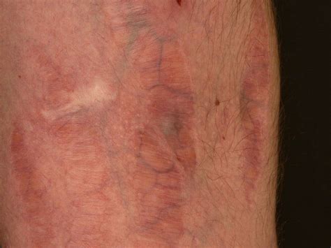 Uncovering the Hidden Layers: The Emotional Journey Through Pictures of Skin Atrophy