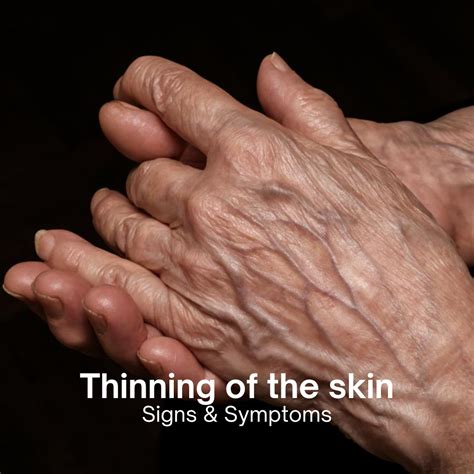 Captivating Images of Thinning Skin: A Visual Journey through Aging and Skin Health