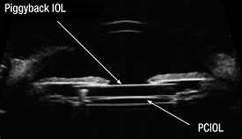 Piggyback Iol Calculator