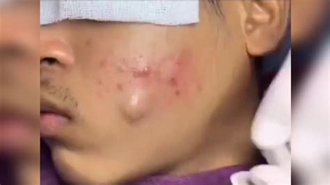 Pimple Pop from Hell: Exploding Zit Liquefies Face