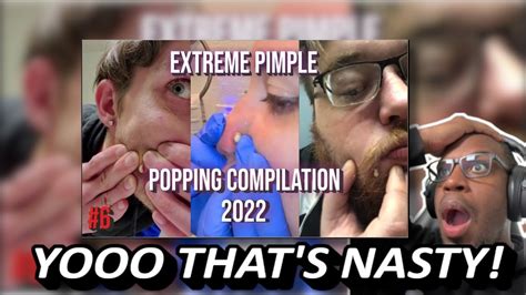 Get Ready for 2022's Best Pimple Popping Videos - Clear Skin, Clear Mind!